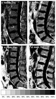 Vertebral Bone Marrow Heterogeneity Using Texture Analysis of Chemical Shift Encoding-Based MRI: Variations in Age, Sex, and Anatomical Location